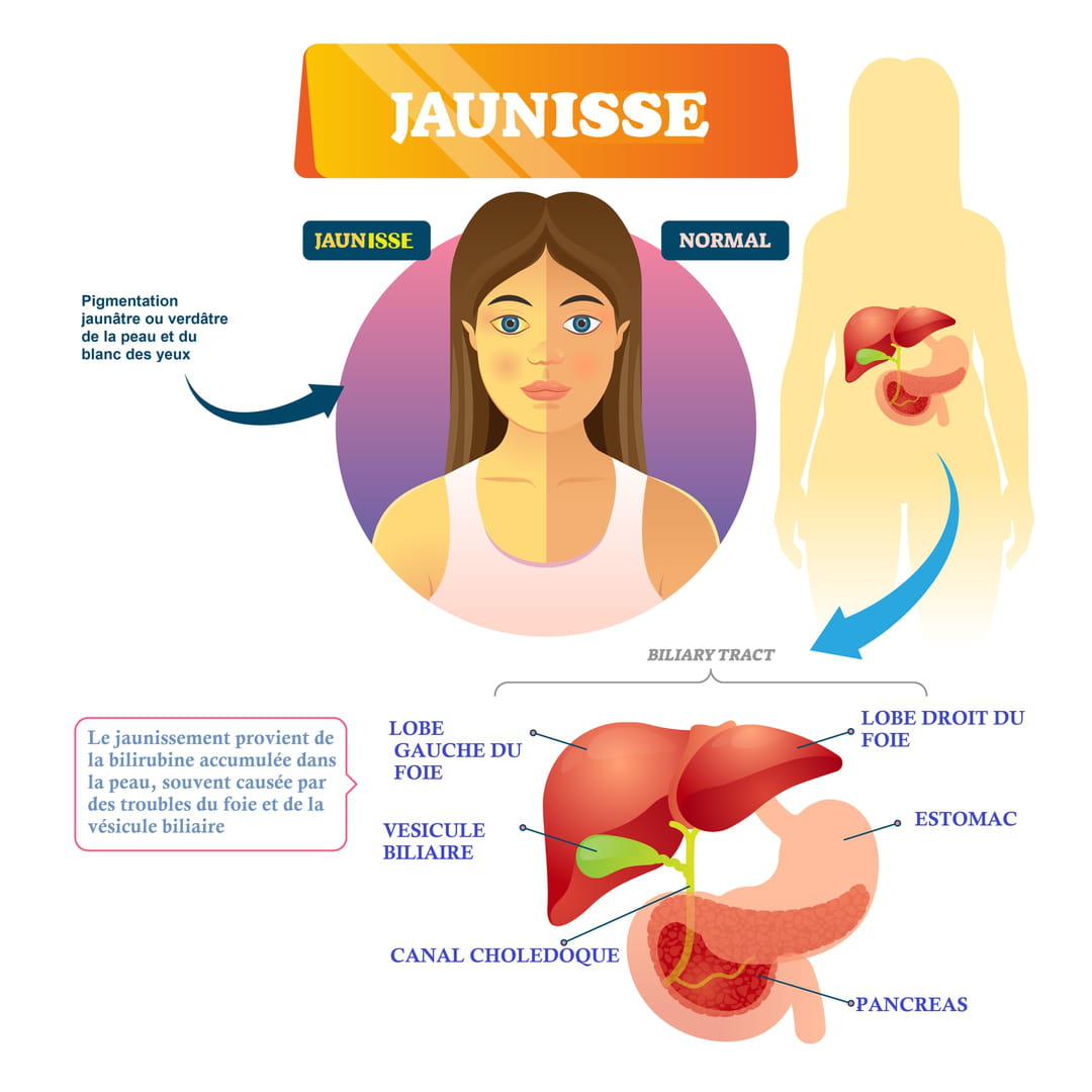 Diarrhée jaune : comprendre ses origines et les solutions à adopter